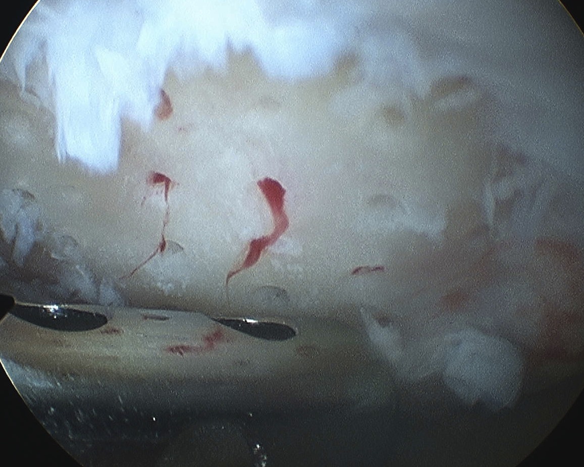 Microfracture Awl Holes Bleeding